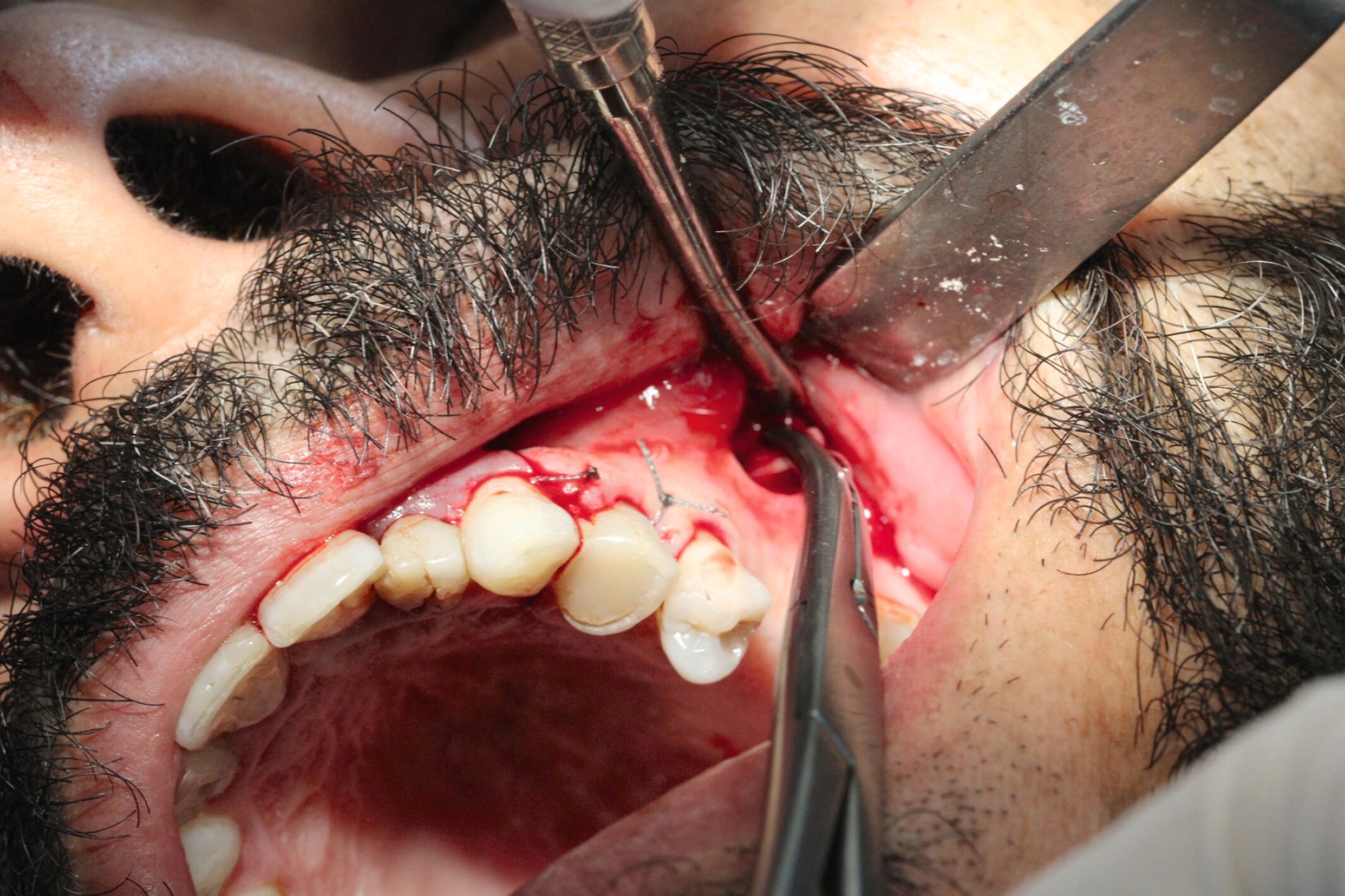 Abbildung 3a: Entfernung der Zyste Regio 26 aus der Kieferhöhle über einen zweiten Zugang sowie die versorgte Wunde Regio 24 nach Wurzelspitzenresektion.