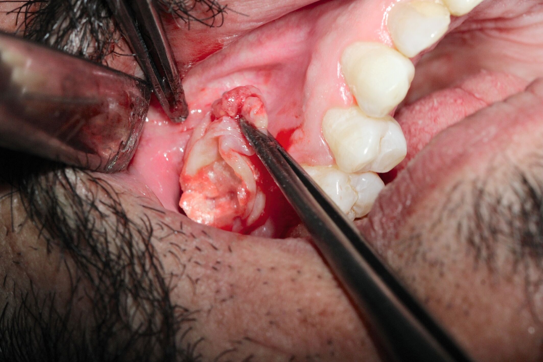 Abb. 3b: Entfernung der Zyste Regio 16 aus der Kieferhöhle.