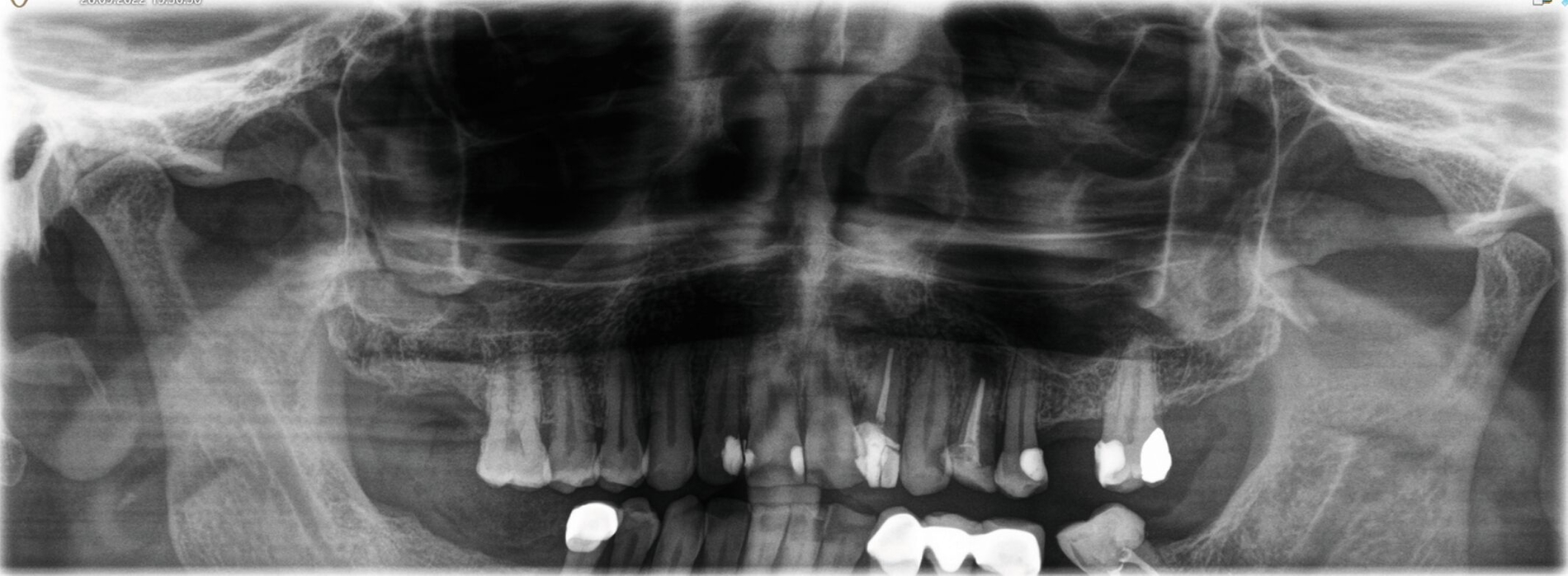 Abb. 4: Postoperatives OPG nach Zystektomie beidseits.