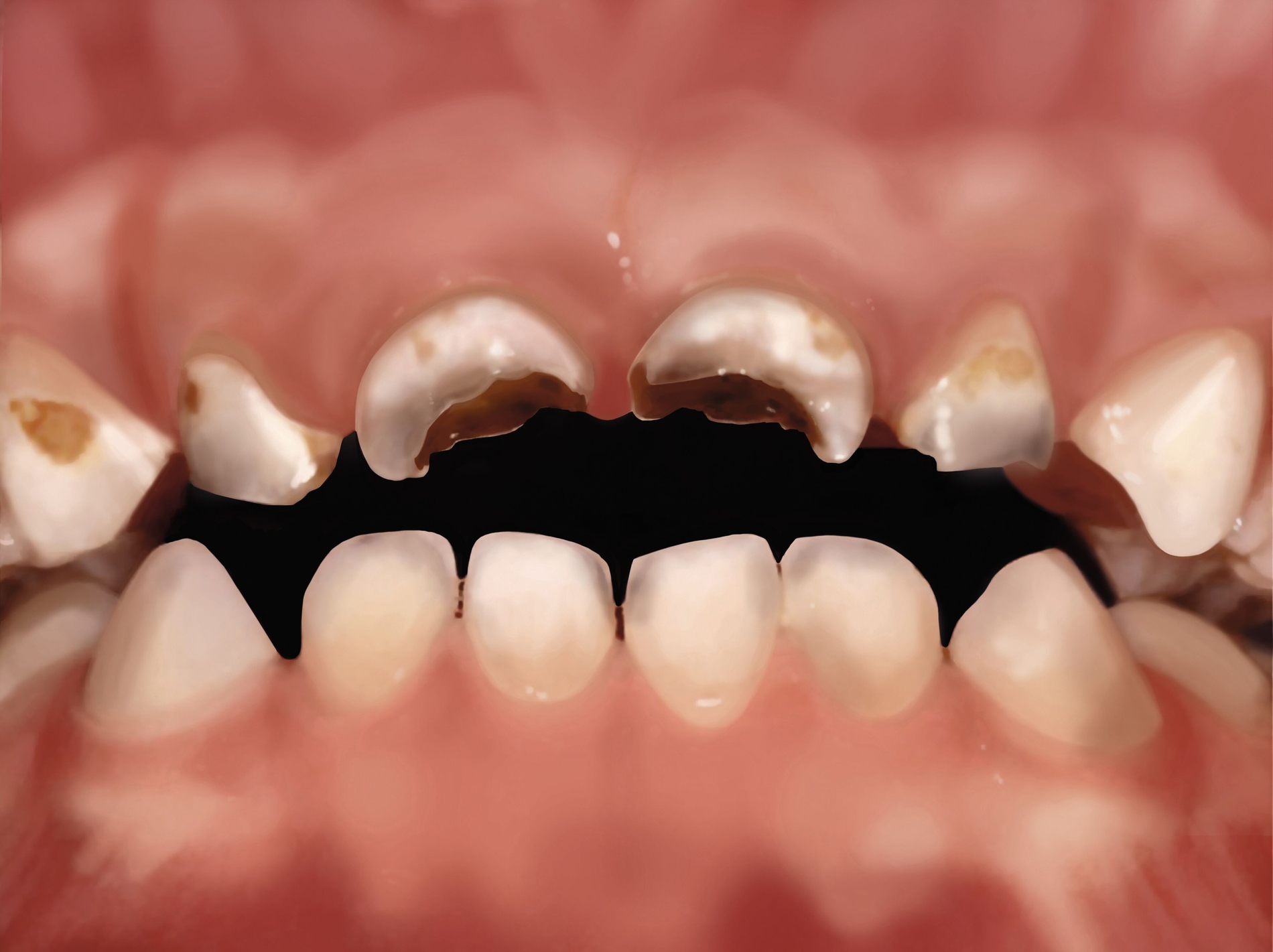 Ist die Nuckelflasche als ständiger Begleiter mit Milch, süßem Tee oder Saft gefüllt, besteht die Gefahr für schlechte Zähne, eine sogenannte Nuckelflaschenkaries. Bakterien im Mund verwandeln Zucker zu Säure, die den Zahn entkalkt und langsam zerstört. Auch natürlicher Zucker in Fruchtsäften kann Ursache für schlechte Zähne sein. Enthalten die Getränke zusätzlich Fruchtsäure, wird dieser Effekt verstärkt. Auch das Verdünnen der Säfte mit Wasser hilft nicht gegen Zahnschäden. Eltern sollten ihren Kindern die Nuckelflasche nicht zum Dauernuckeln überlassen. Idealer Durstlöscher ist Wasser. Sobald das Kind im Alter von etwa 9 Monaten sitzen kann, sollte es sich daran gewöhnen, aus dem Becher zu trinken. Ab dem ersten Geburtstag sollten Eltern keine Nuckelflasche mehr geben. Auch Kinder, die noch sehr lange gestillt werden, nachdem die ersten Zähne da sind, haben ein erhöhtes Risiko für Karies. Nuckelflasche und Stillen dürfen also kein Mittel zur Beruhigung des Kindes sein. Beides sollte rein der Nahrungsaufnahme dienen. Regelmäßiges Zähneputzen hilft aber gegen die Zahnzerstörung. Eine zahngesunde Ernährung mit wenig Zucker beugt ebenfalls schlechten Kinderzähnen vor. Insbesondere sollten Eltern auf zuckerreiche Kinderprodukte wie z.B. Quetschies verzichten. Besser ist frisches Obst.