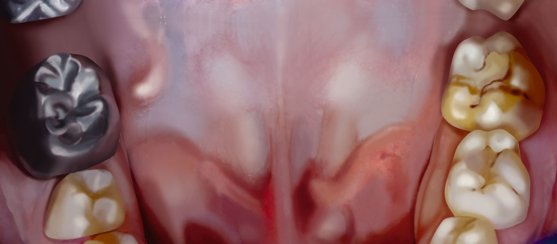 Die Molaren-Inzisiven-Hypomineralisation (MIH) ist eine Mineralisationsstörung des Zahnschmelzes bei Kindern. Der Schmelz ist fleckig, weich und anfällig für Schäden (rechts). Zum Teil ist ein Zahn so stark zerstört, dass nur eine Stahlkrone den Defekt ersetzen kann (links). In der Folge sind das Ziehen des Zahns und eine kieferorthopädische Behandlung zum Schließen der Lücke in Betracht zu ziehen.