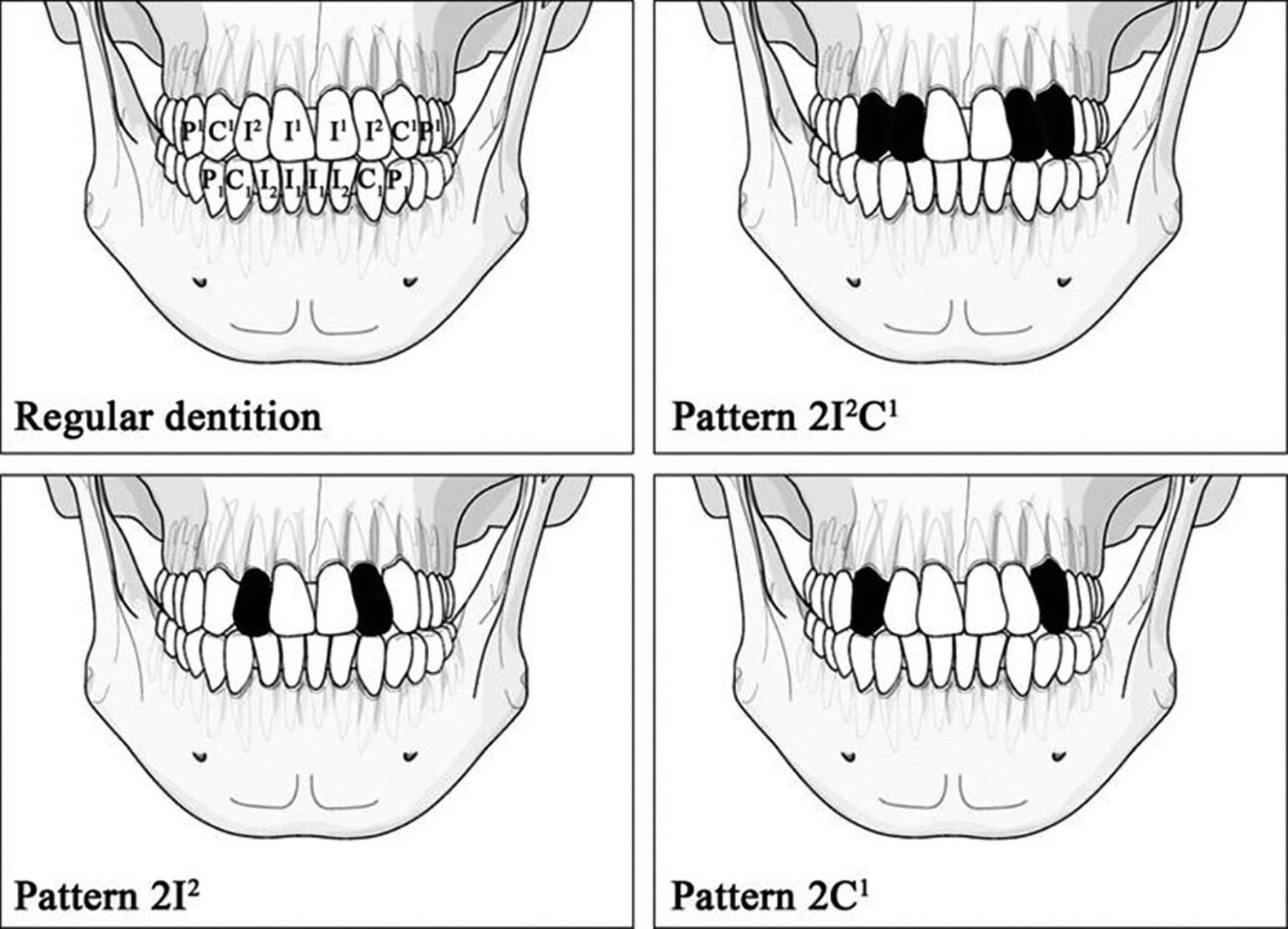 Regelhaftes Gebiss mit vorherrschenden Ablationsmustern bei alten und heutigen Populationen in Taiwan. Schwarze Blöcke stellen extrahierte Zähne dar.