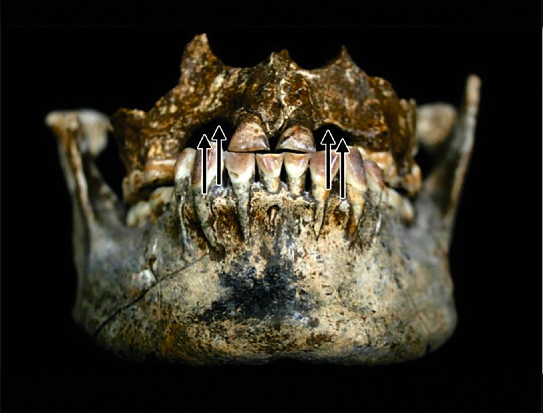 Schädel von Song Keplek 5 (Java, Indonesien) mit 2I2C1-Zahnablation, gekennzeichnet durch Pfeile