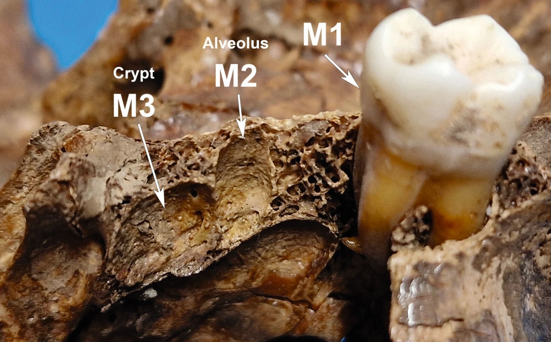Die teilweise erhaltene Alveole des oberen zweiten Molaren (M2 ) und die Krypta des oberen dritten Molaren (M3 ) im linken Oberkiefer.