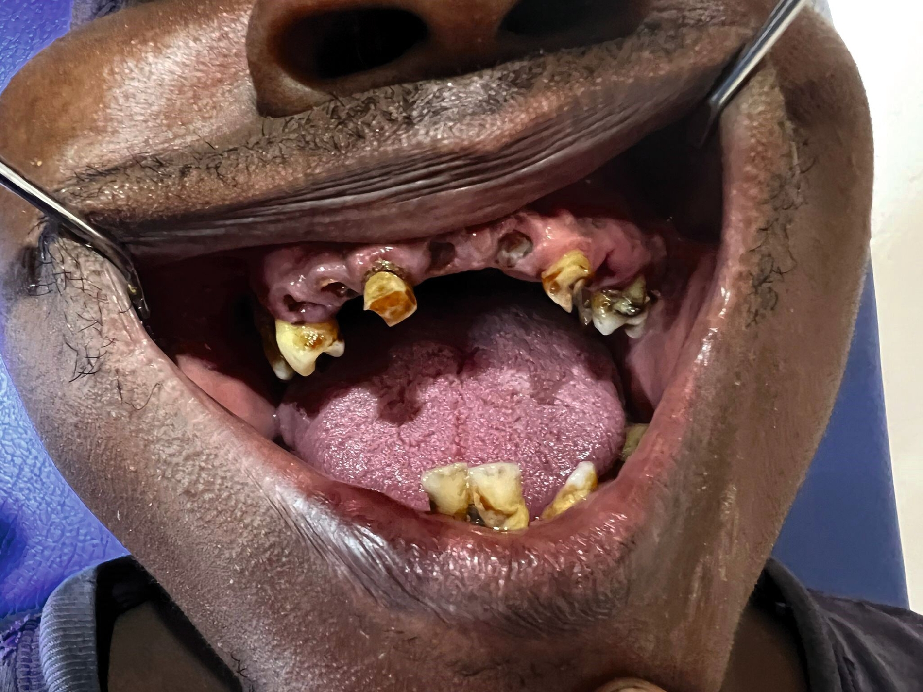 Zahnmedizinische Behandlung im Gefängnis auf Madagaskar