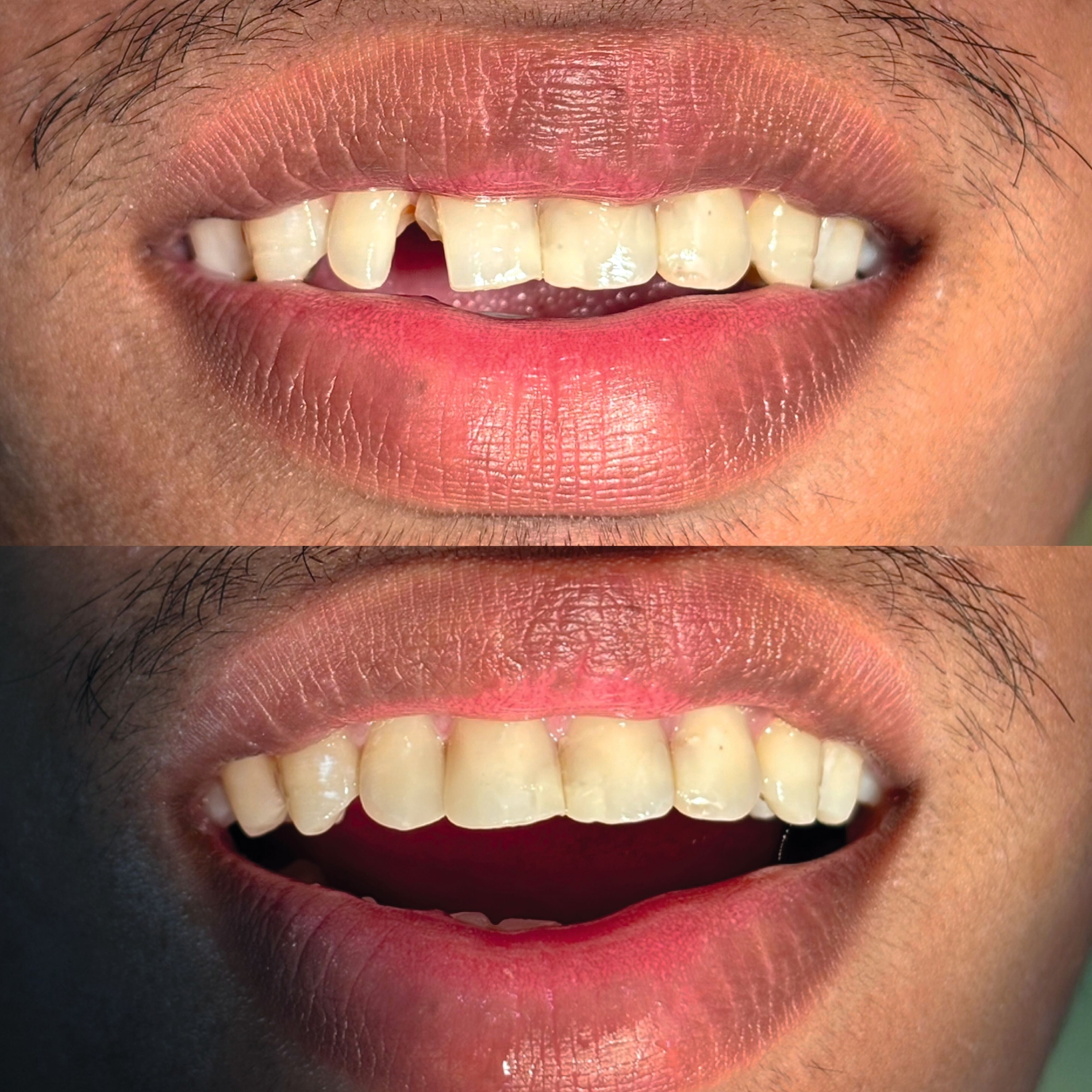 Mini Molars in Kambodscha