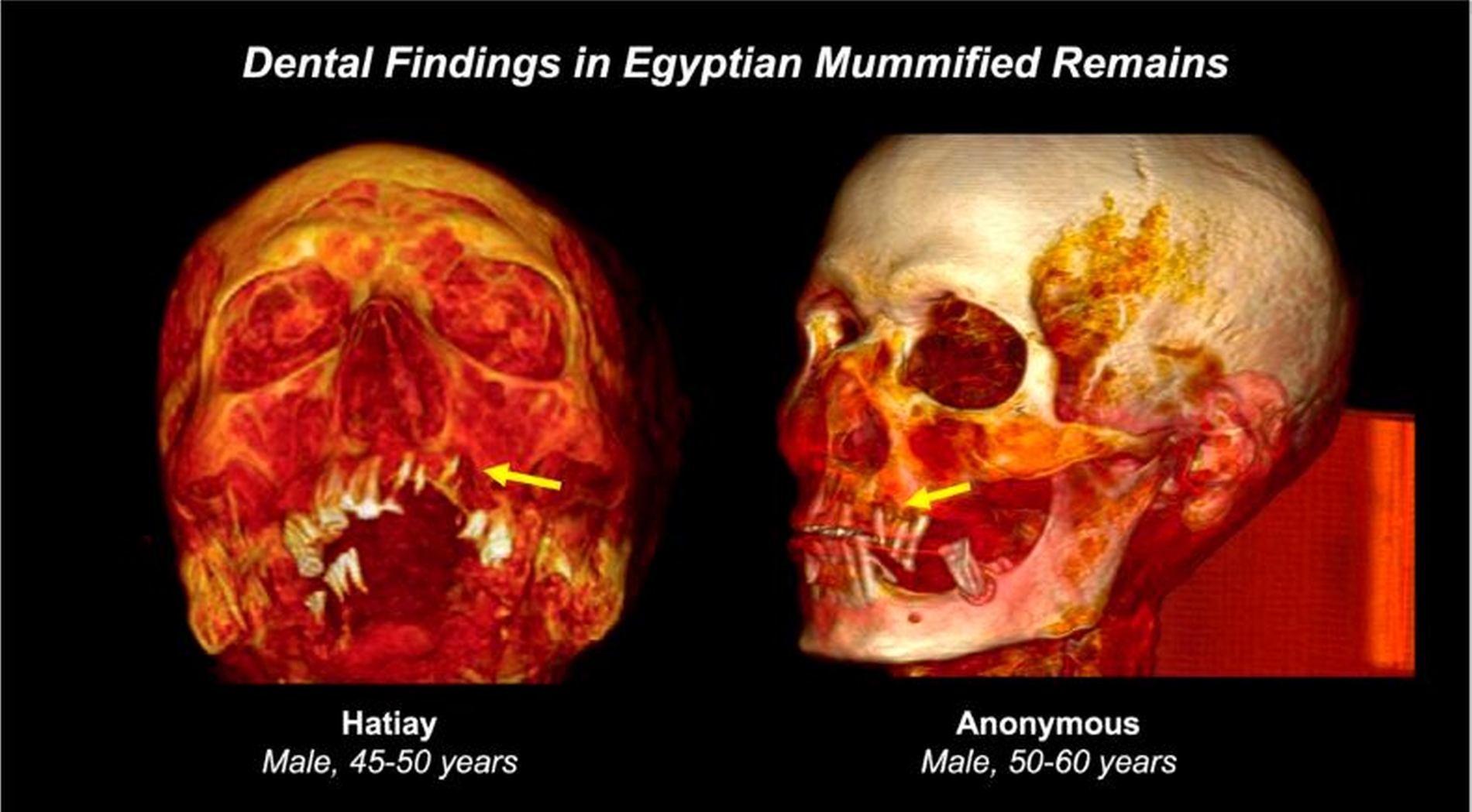 Dreidimensionale Rekonstruktionen von CT-Scans der Schädel zweier genannter ägyptischer Mumien aus der Horus-Studie.