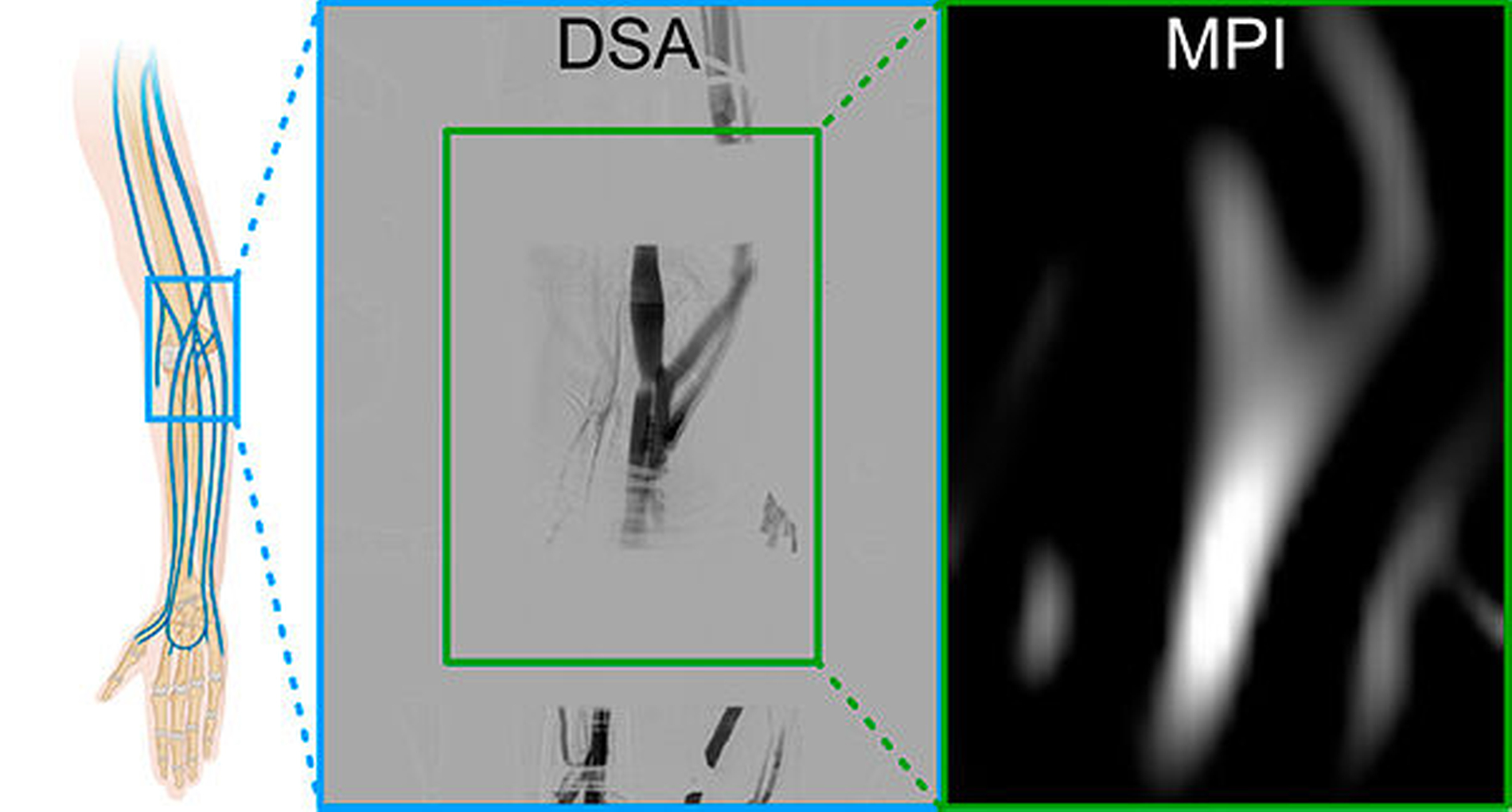 Vergleich von MPI-Angiographie (MPA) und Digitaler Subtraktionsangiographie (DSA). Die aus der jeweiligen Echtzeitserie ausgewählten Bilder zeigen die maximal kontrastmittelgefüllten Venen im Arm des Probanden.