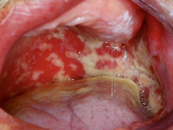 Mukositis-Oral_Kaemmerer.jpg Mukositis-Oral_Kaemmerer.jpg