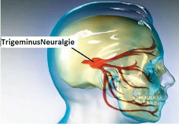 TrigeminusNeuralgie_zahnschmerzennachfullung.blogspot.jpg TrigeminusNeuralgie_zahnschmerzennachfullung.blogspot.jpg